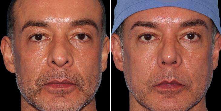 Male Open Rhinoplasty Before & After Atlanta